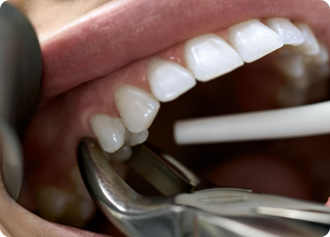 Easy Tooth Extraction Comprehensive Oral Surgery Services - Clear Smiles Dental
